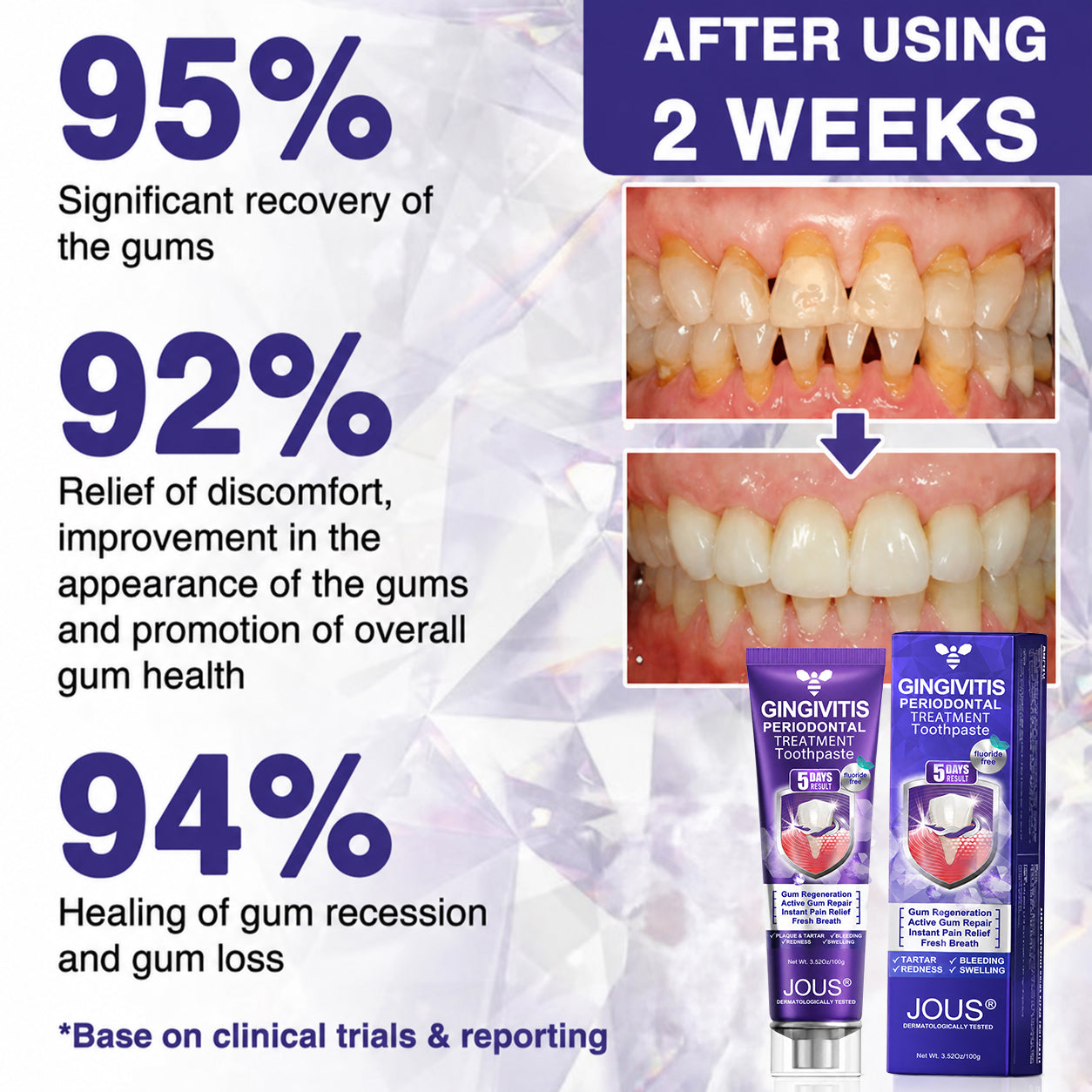 🦷JOUS® VioCore ✨ Bee Venom Gingivitis & Periodontitis Treatment Toothpaste