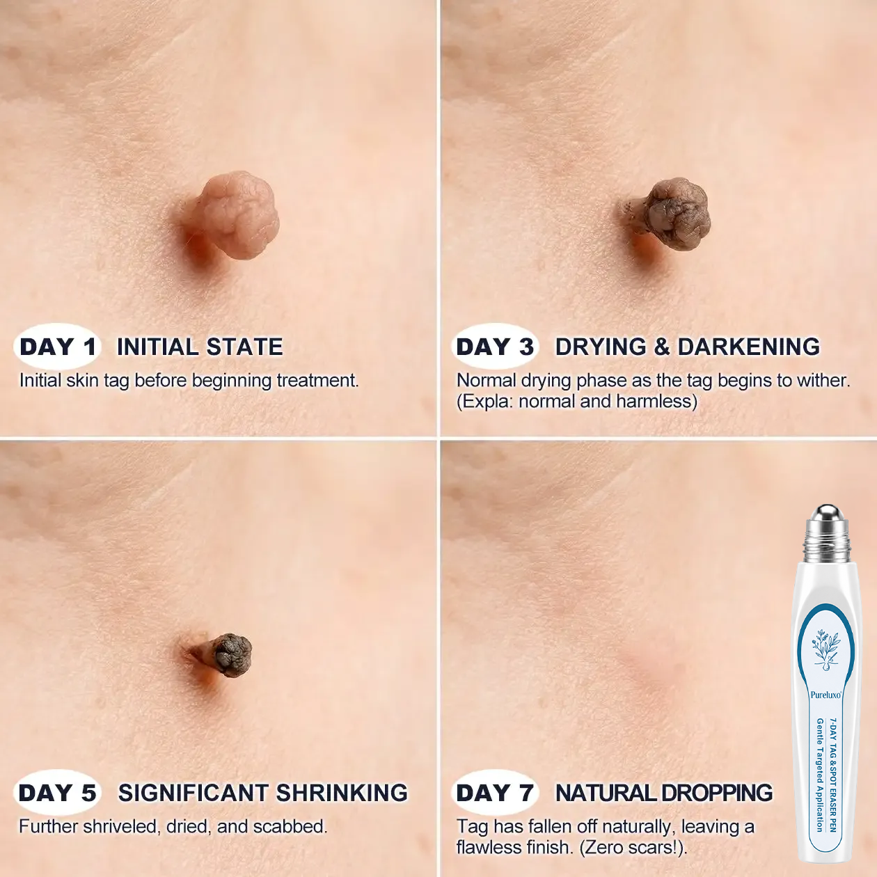 JOUS®👽 𝟕-𝐃𝒂𝘆 𝐒𝗸𝐢𝐧 𝐓𝒂𝗴 & 𝐒𝐩𝙤𝐭 𝐄𝐫𝒂𝐬𝙚𝐫 Painless & Scar-Free Advanced Imperfection Removal Rollerball Pen