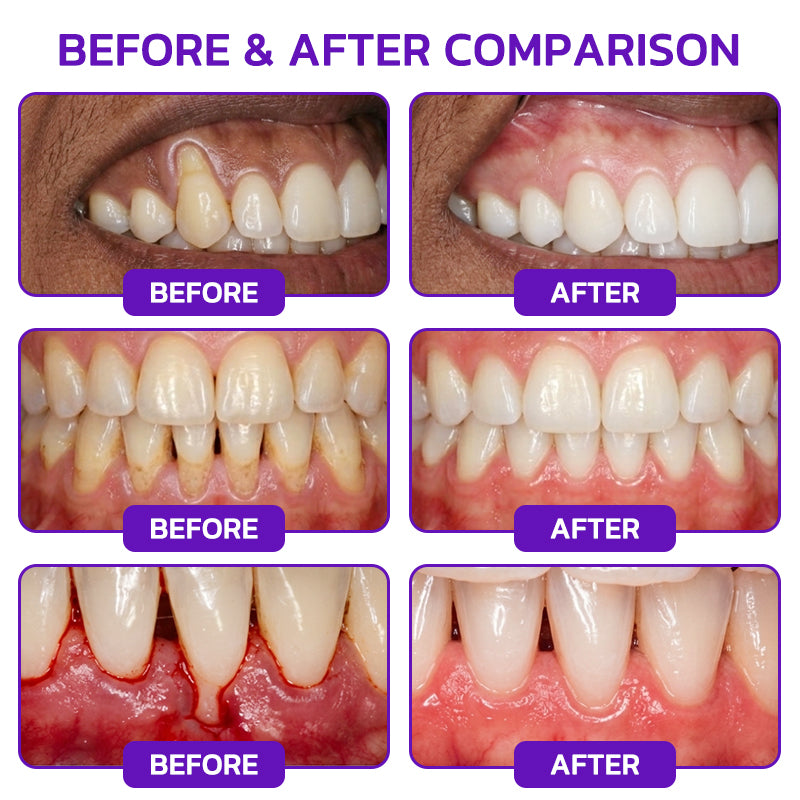🦷🥇JOUS® VioCore Bee Venom Gingivitis & Periodontitis Treatment Toothpaste
